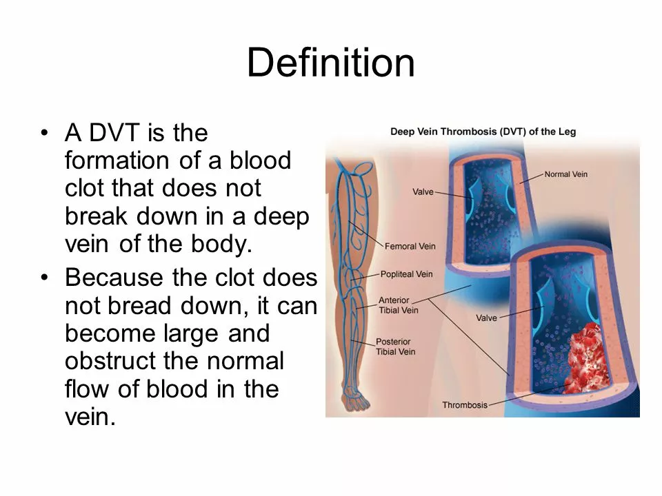 The Role of Physical Therapy in DVT Rehabilitation