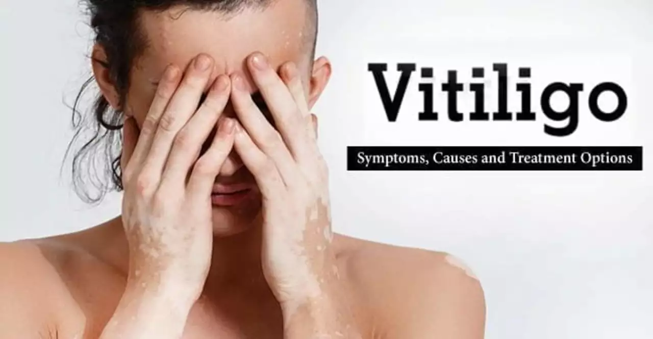 The Effectiveness of Halobetasol in Treating Vitiligo